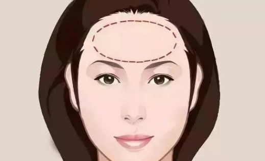喬雅登雅致適合做哪些部位？皺紋拜拜|玻尿酸去抬頭紋案例附上