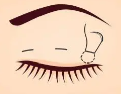 雙眼皮17.png