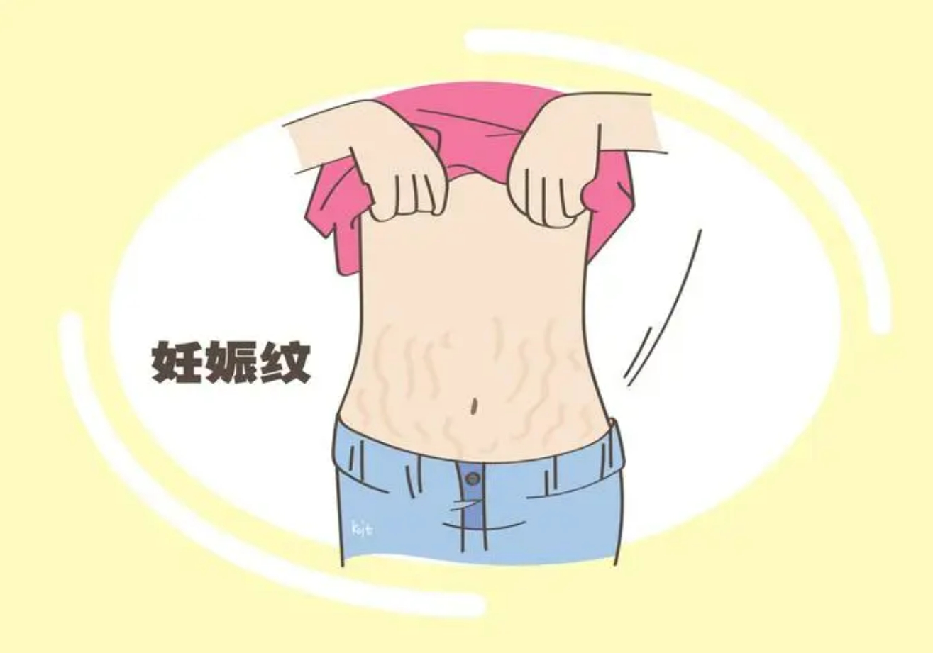 激光改良妊娠紋2.png
